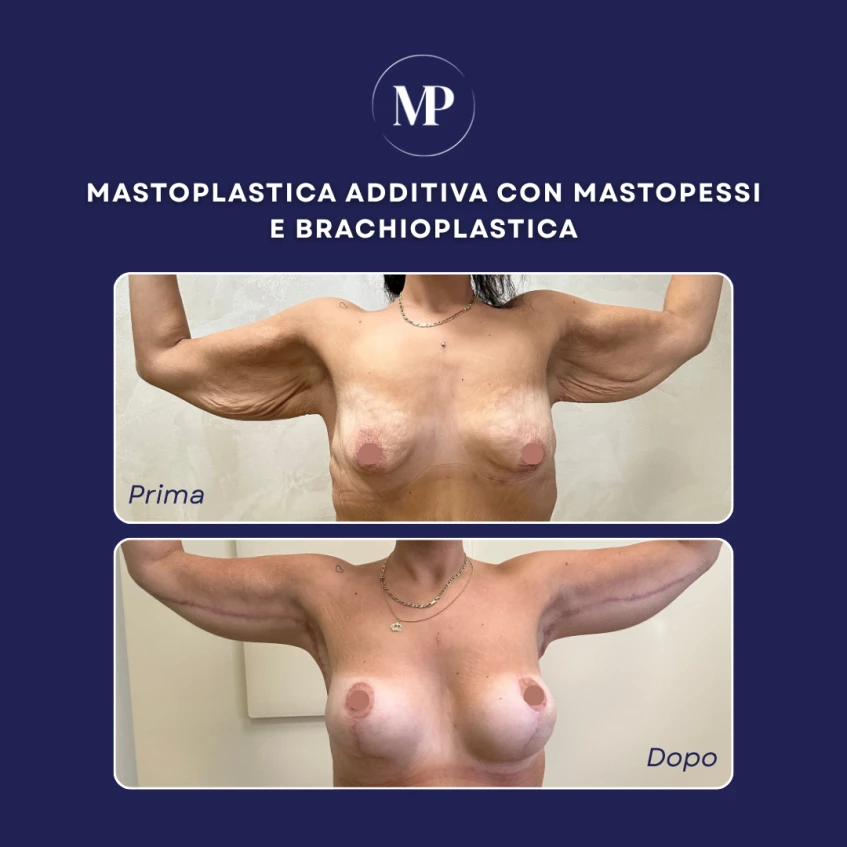  Brachioplastica Dott. Mario Prandi 